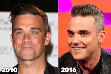 Robbie Williams, esagera col botox